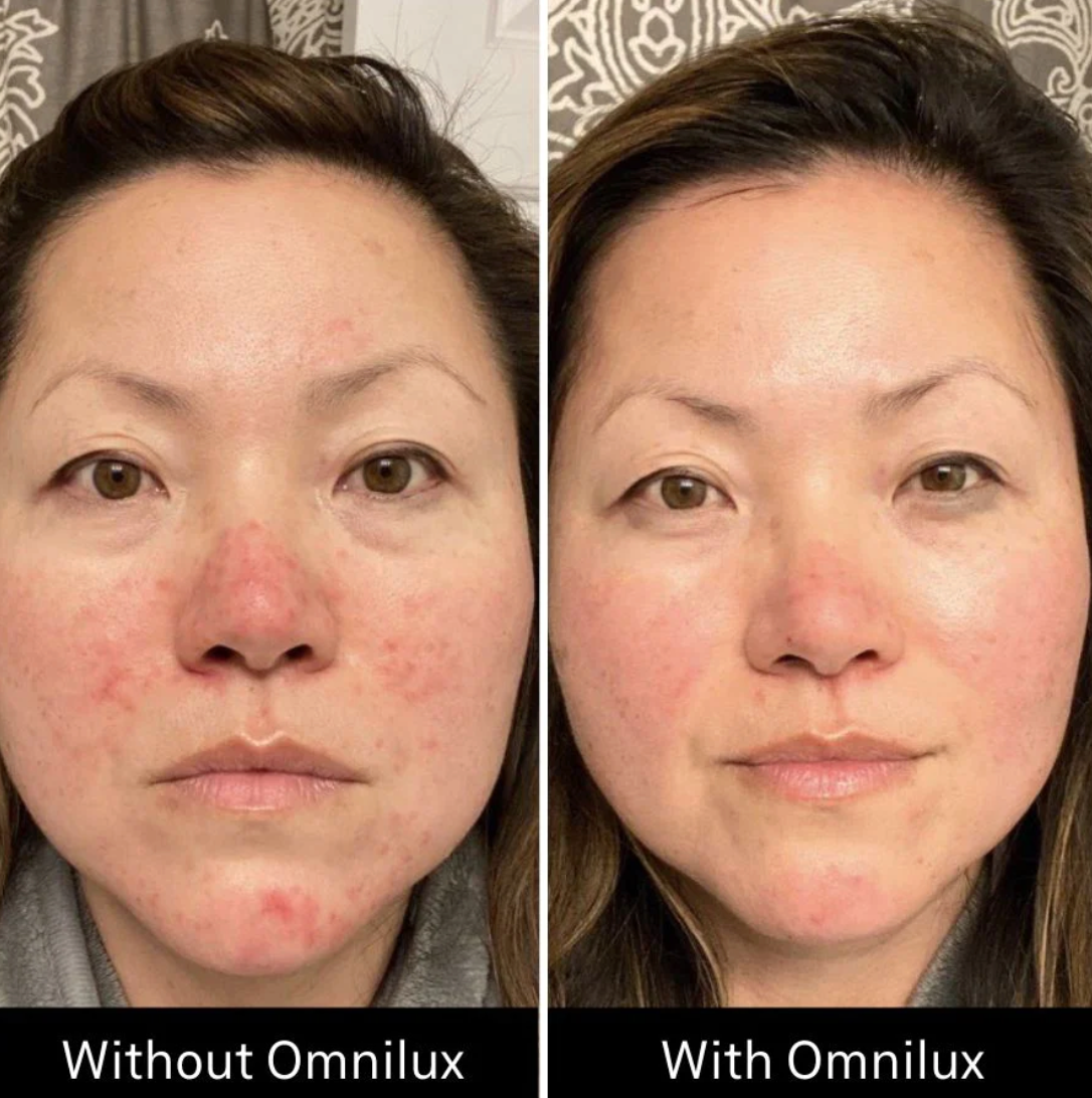 Omnilux Contour Face Red Light Therapy