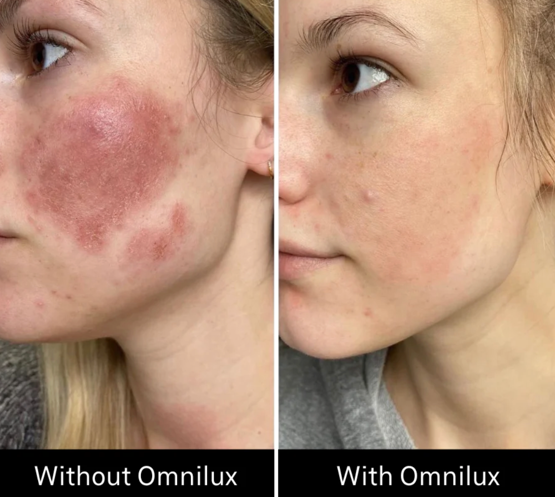 Omnilux Contour Face Red Light Therapy