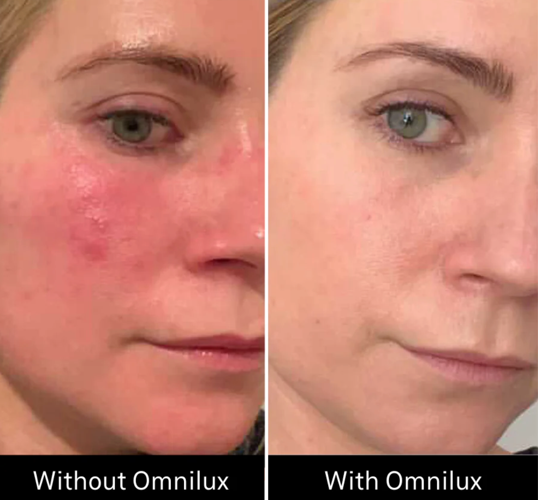 Omnilux Contour Face Red Light Therapy